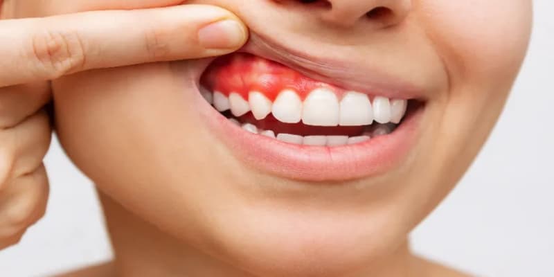 Diş Eti Ameliyatı Zor Mu? Bilmeniz Gerekenler